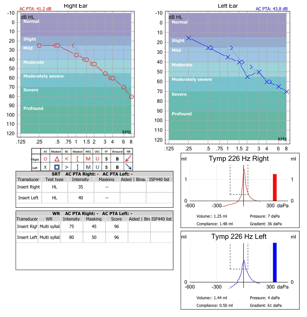Sample audiogram report: right- and left-ear hearing thresholds, the test symbol key, speech testing results, and middle-ear tympanometry (illustrative)