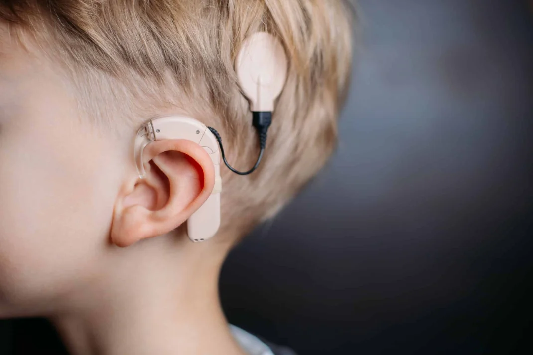 A child wearing a cochlear implant — a behind-the-ear sound processor with a thin cable running to a round transmitter coil held against the head.